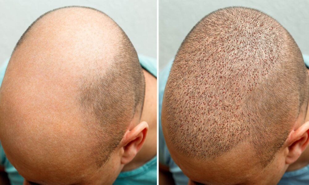 Hair Transplant: Understanding the Cost of Turkey Comprehensive Guide